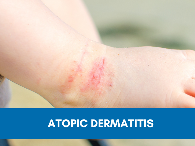 Atopic Dermatitis Signs And Symptoms Eczema Signs And Symptoms Patientsengage